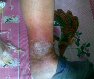 济南中医静脉曲张医院