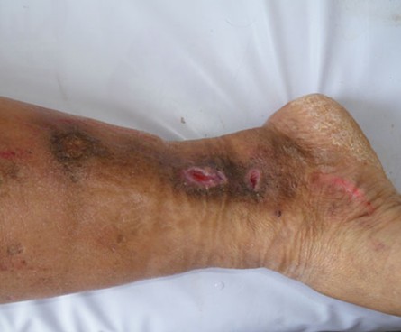 济南中医静脉曲张医院