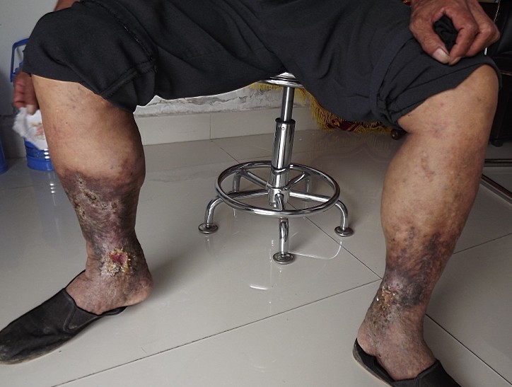 济南中医静脉曲张医院