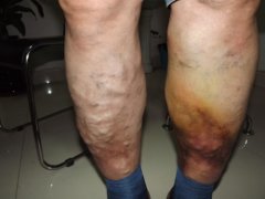 济南中医静脉曲张医院