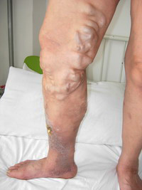 济南中医静脉曲张医院