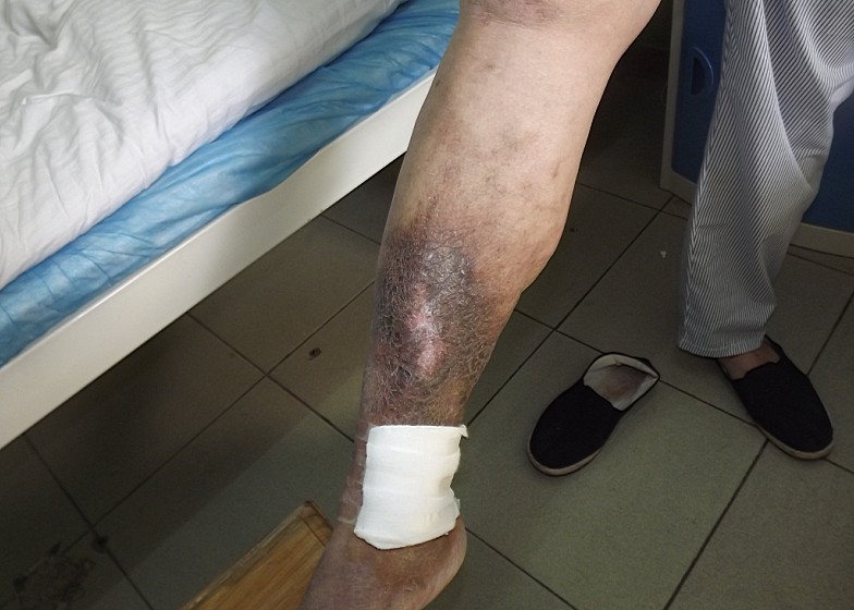 济南中医静脉曲张医院