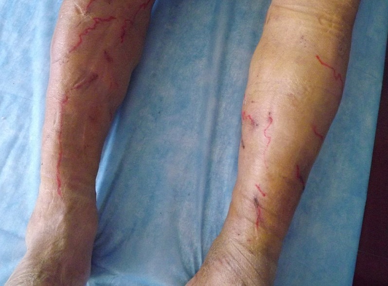 济南中医静脉曲张医院