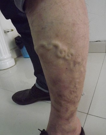 济南中医静脉曲张医院