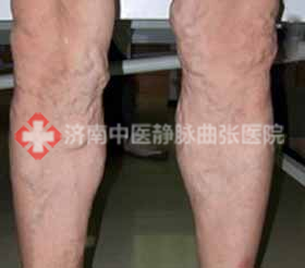 济南中医静脉曲张医院