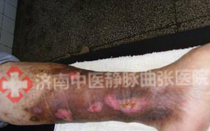 济南中医静脉曲张医院